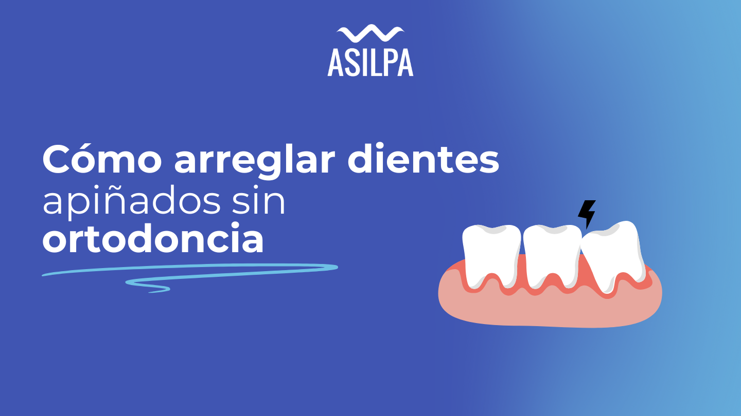 como arreglar dientes apiñados sin ortodoncia
