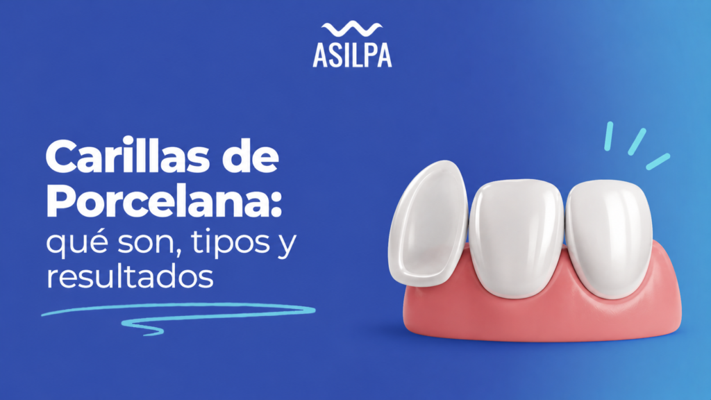Carillas de Porcelana: qué son, tipos y resultados
