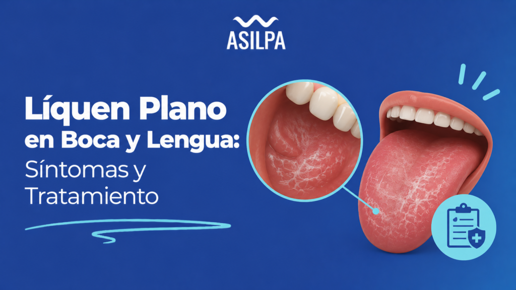 Líquen Plano en Boca y Lengua: Síntomas y Tratamiento
