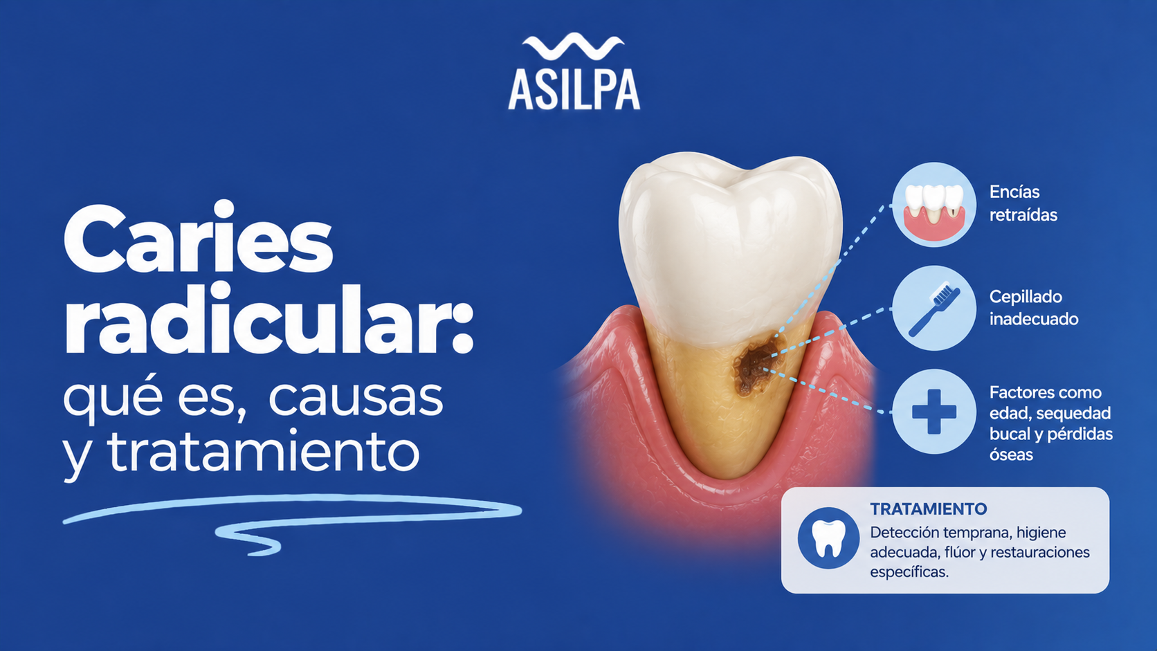 Caries radicular: qué es, causas y tratamiento