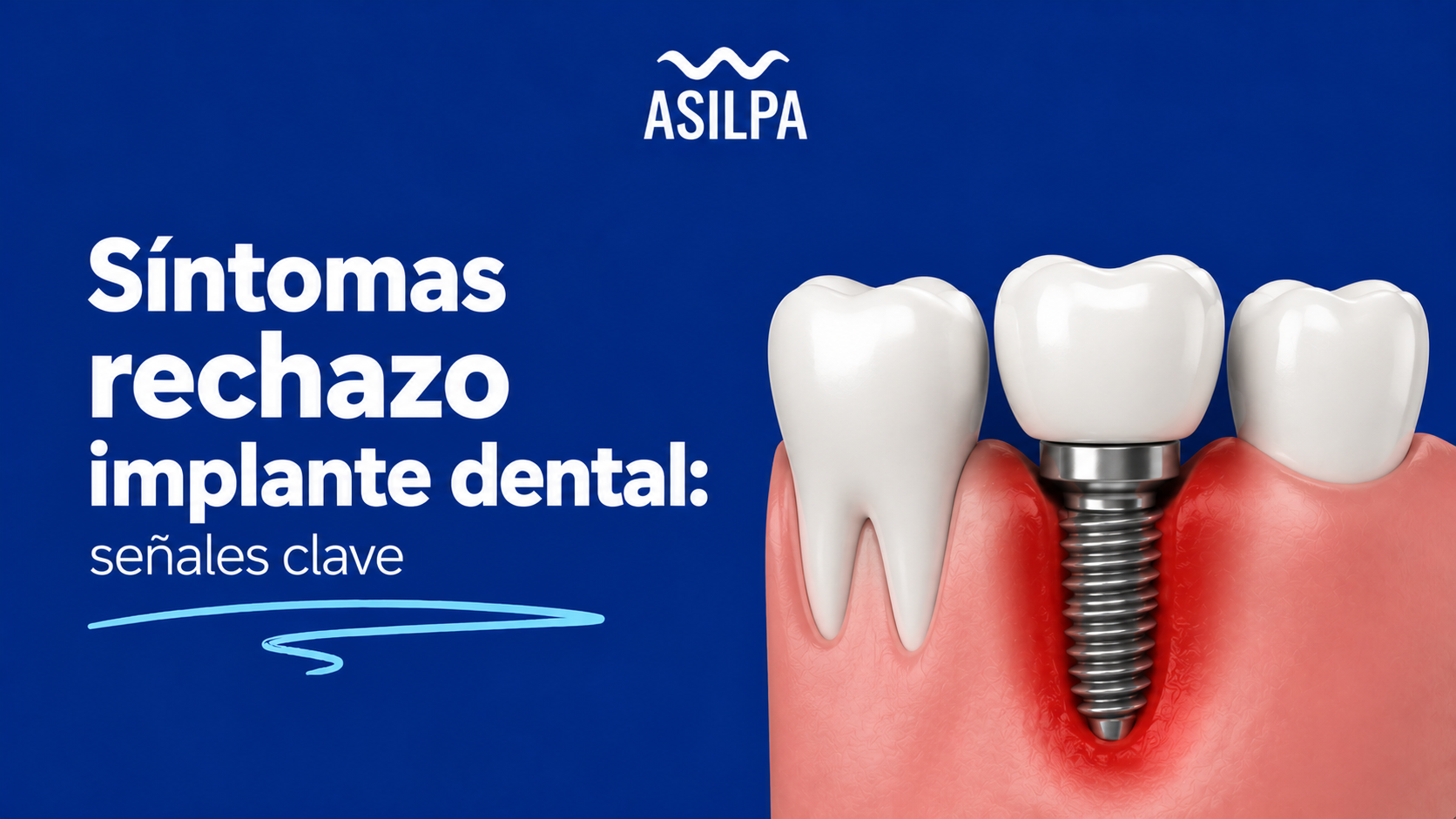 Síntomas rechazo implante dental: señales clave