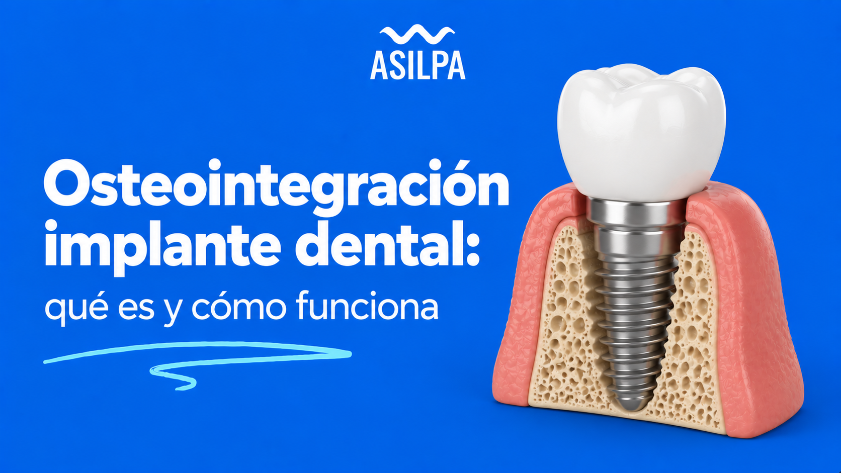 Osteointegración