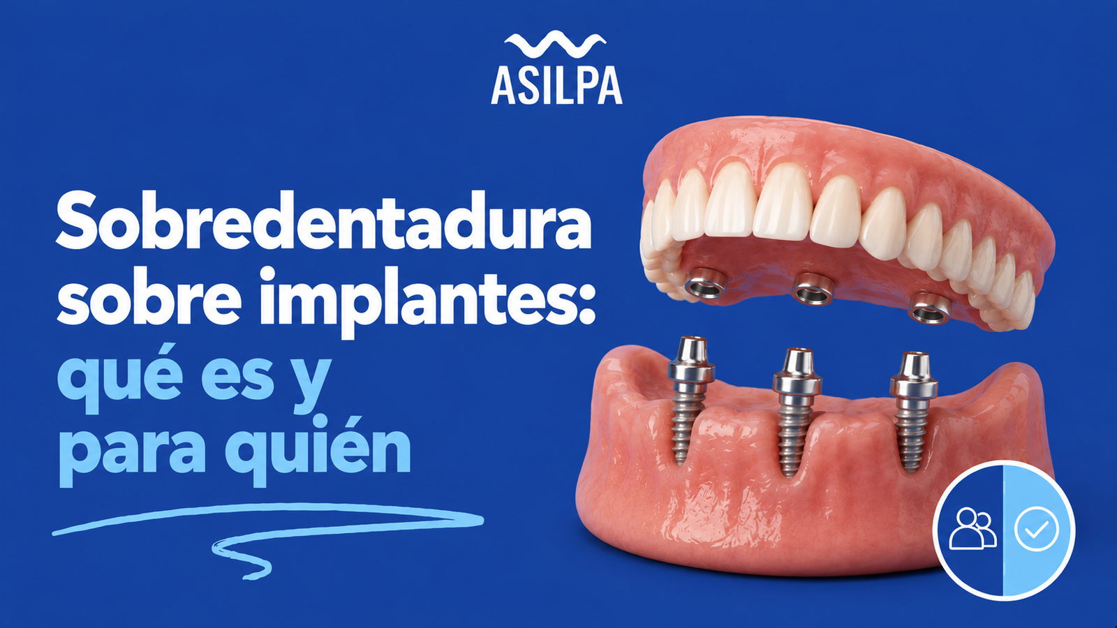 Sobredentadura sobre implantes: qué es y para quién