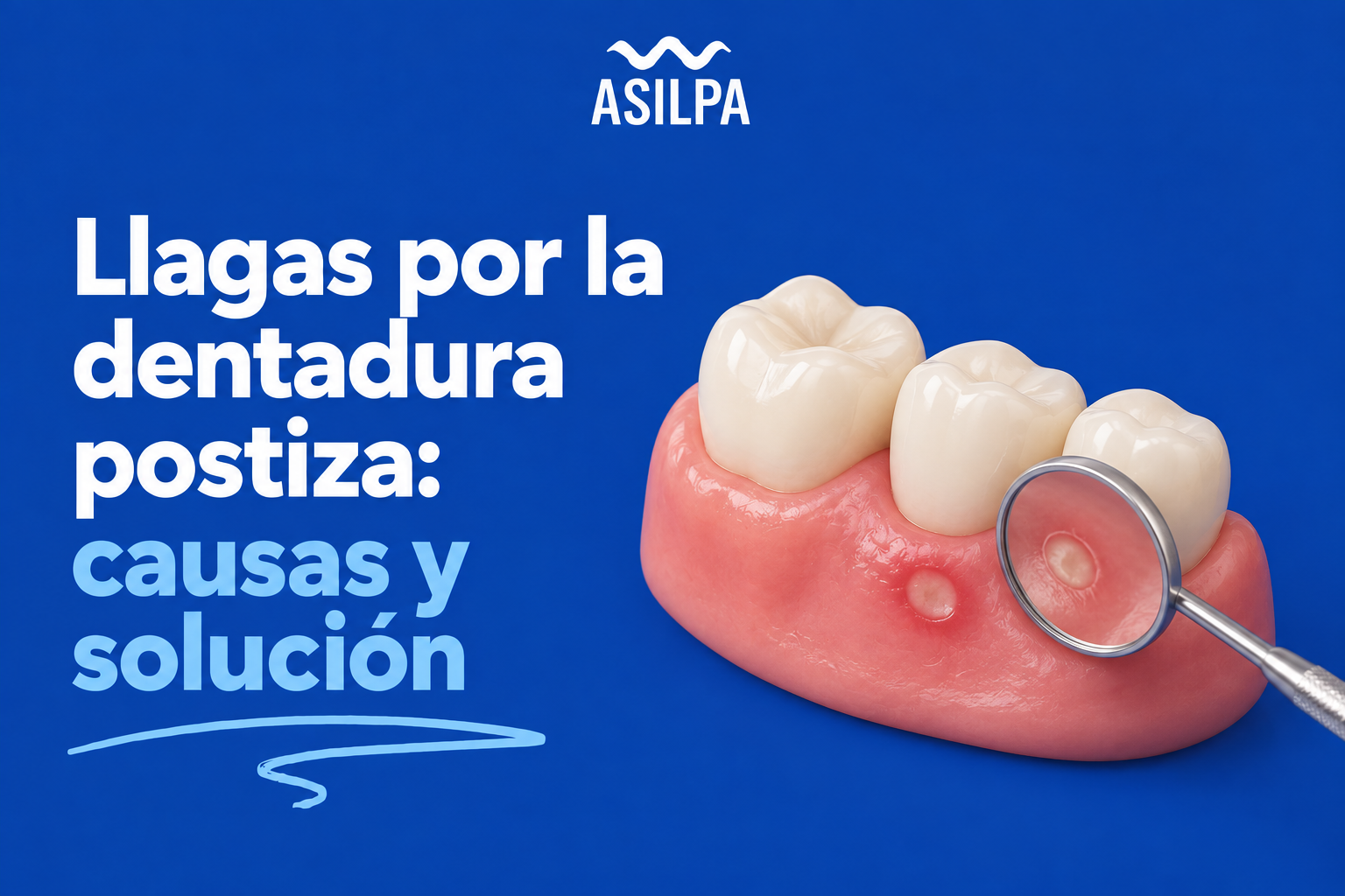 Llagas por la dentadura postiza: causas y solución
