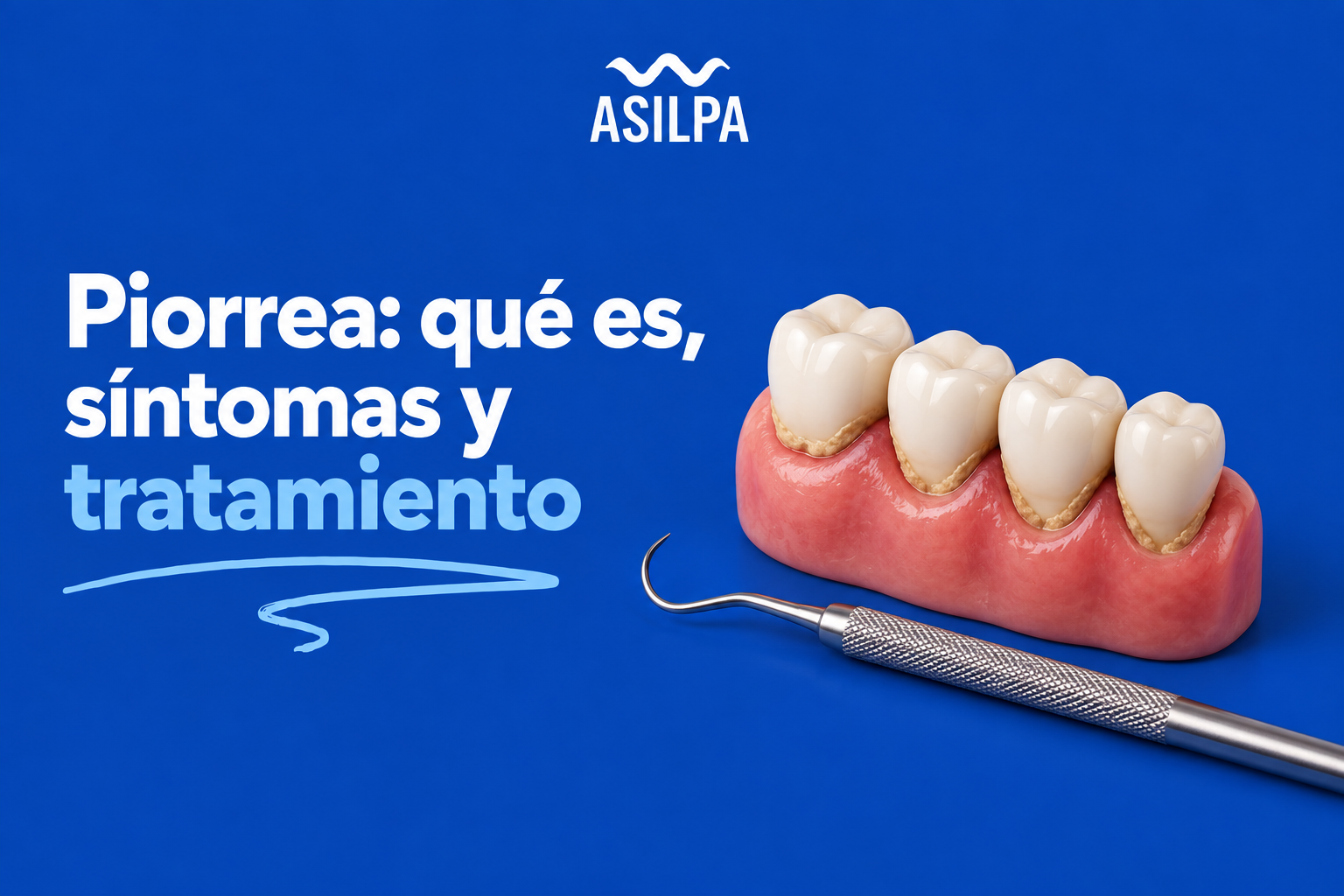 Piorrea: qué es, síntomas y tratamiento